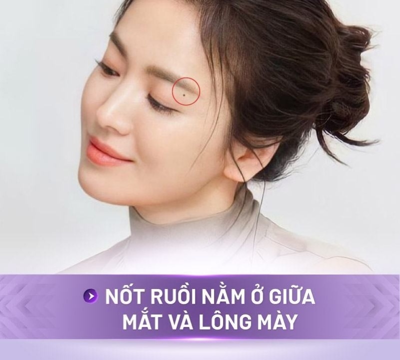 Những nốt ruồi không nên tẩy
