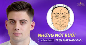 những nốt ruồi nên xóa trên mặt nam giới