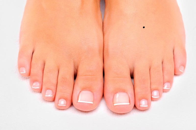 những nốt ruồi nên xóa trên mặt nữ giới