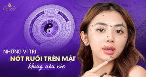 Những vị trí nốt ruồi trên mặt không nên xóa