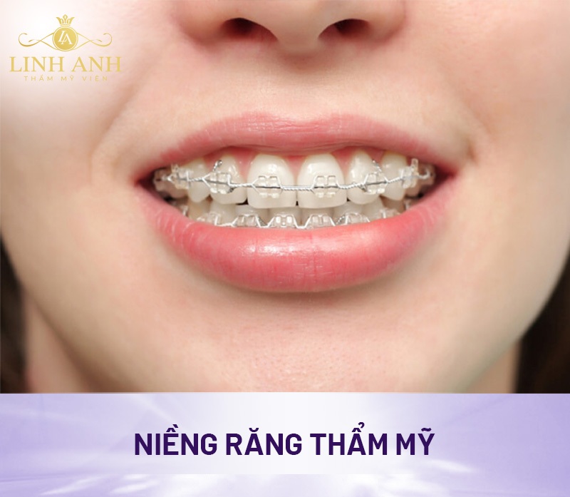 Niềng răng hỗ trợ điều trị cằm lẹm