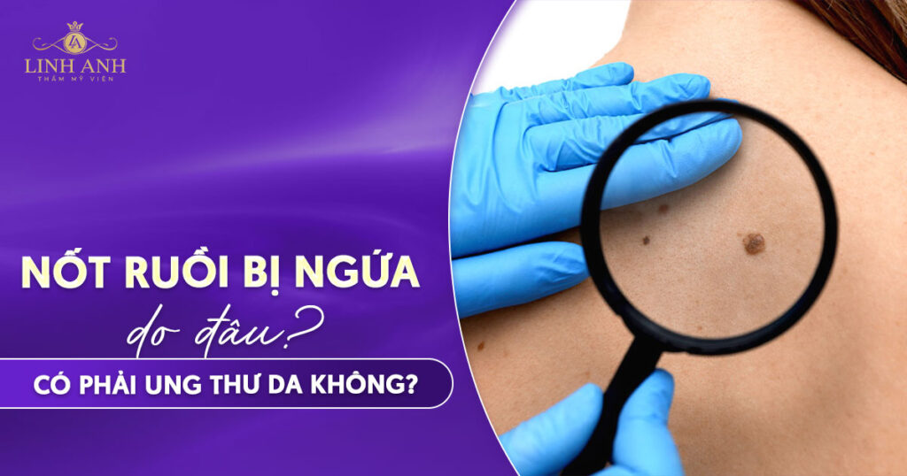 Nốt ruồi bị ngứa