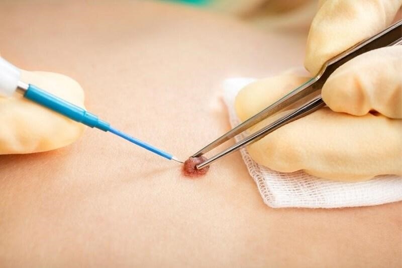 Nốt ruồi bị sưng ngứa