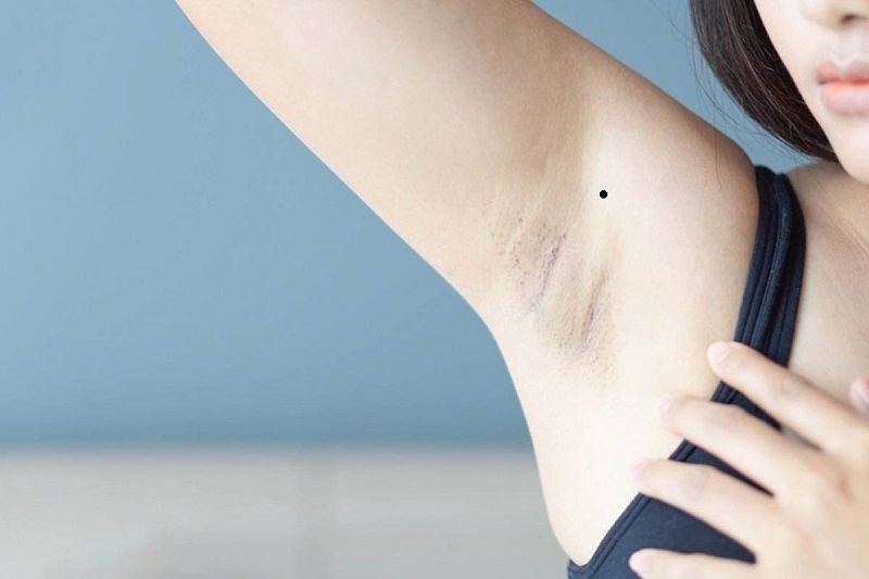 Nốt ruồi gần nách