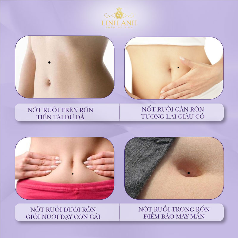 Nốt ruồi gần rốn