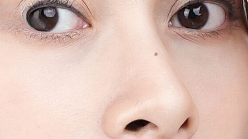 Nốt ruồi giữa sống mũi