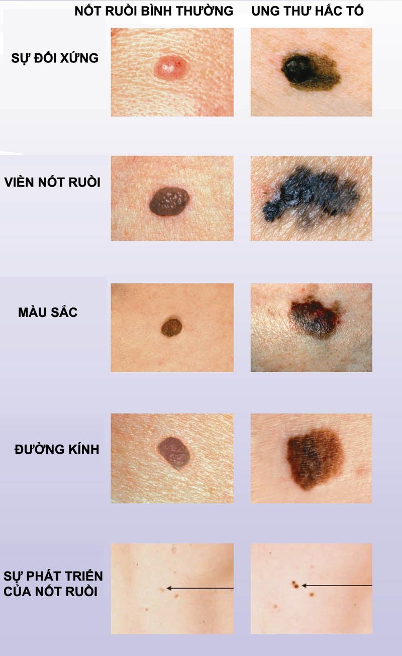 Nốt ruồi ngứa có sao không