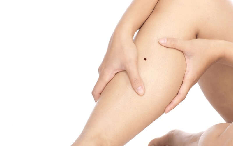nốt ruồi ở cẳng chân trái nữ