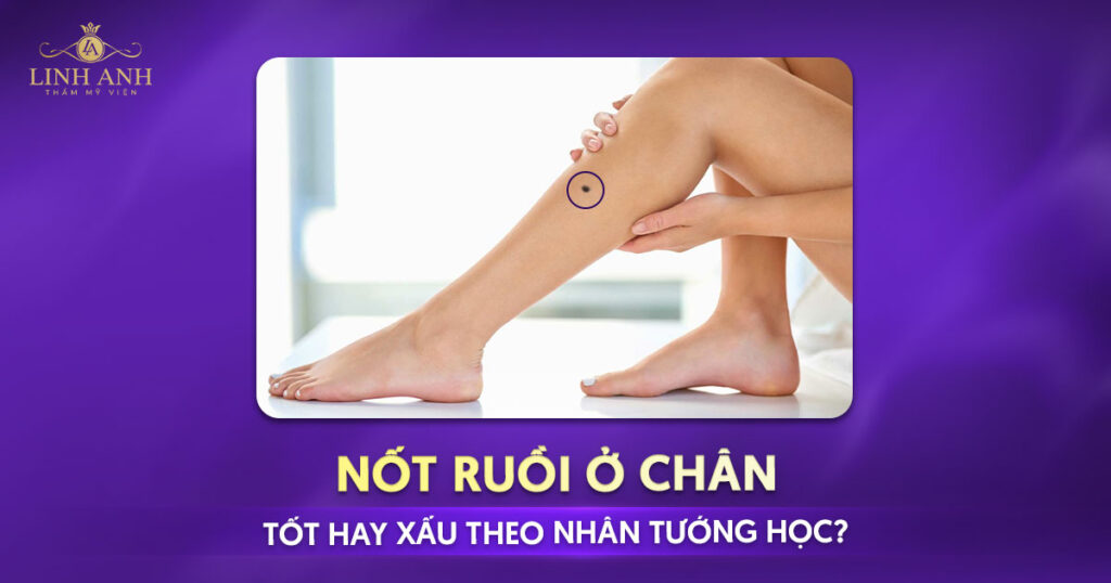 nốt ruồi ở chân