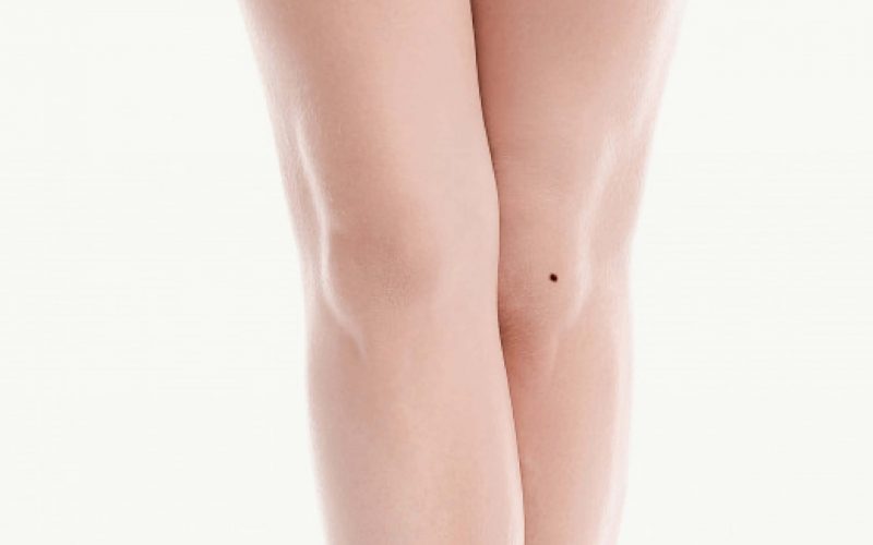 nốt ruồi ở chân trái nữ