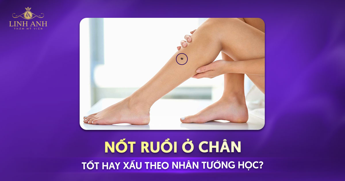 Nốt ruồi ở chân tốt hay xấu theo nhân tướng học?