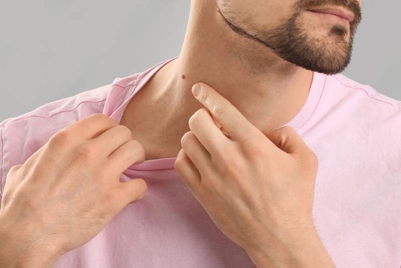 Nốt ruồi ở cổ bên phải nam Nốt ruồi ở cổ bên phải nam
