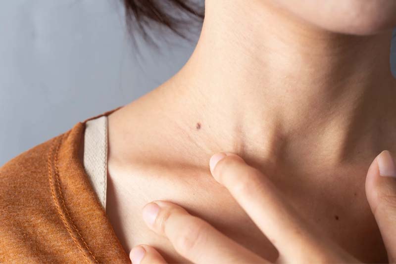 Nốt ruồi ở cổ bên phải nữ Nốt ruồi ở cổ bên phải nữ