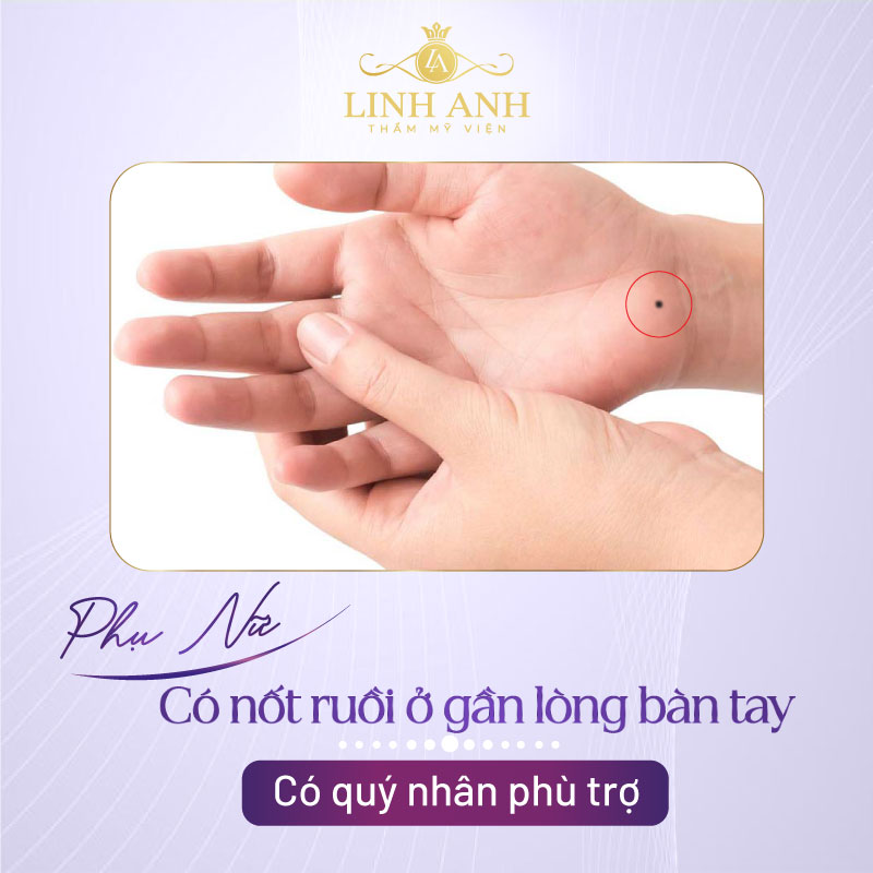 Nốt ruồi ở cổ tay gần lòng bàn tay