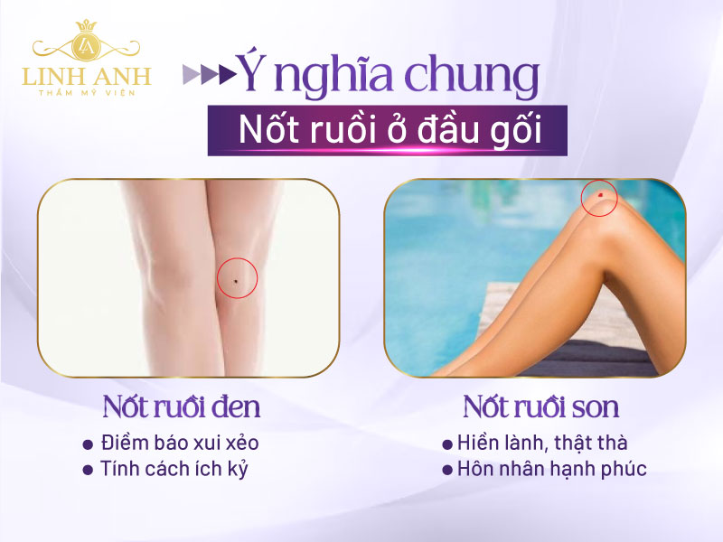 nốt ruồi ở đầu gối phải phụ nữ