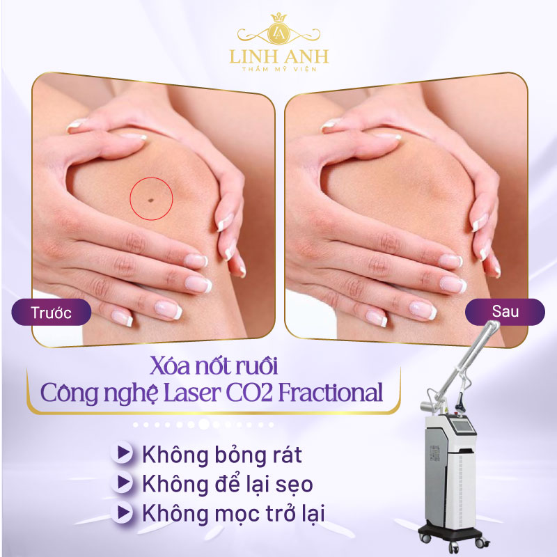 nốt ruồi ở đầu gối phải