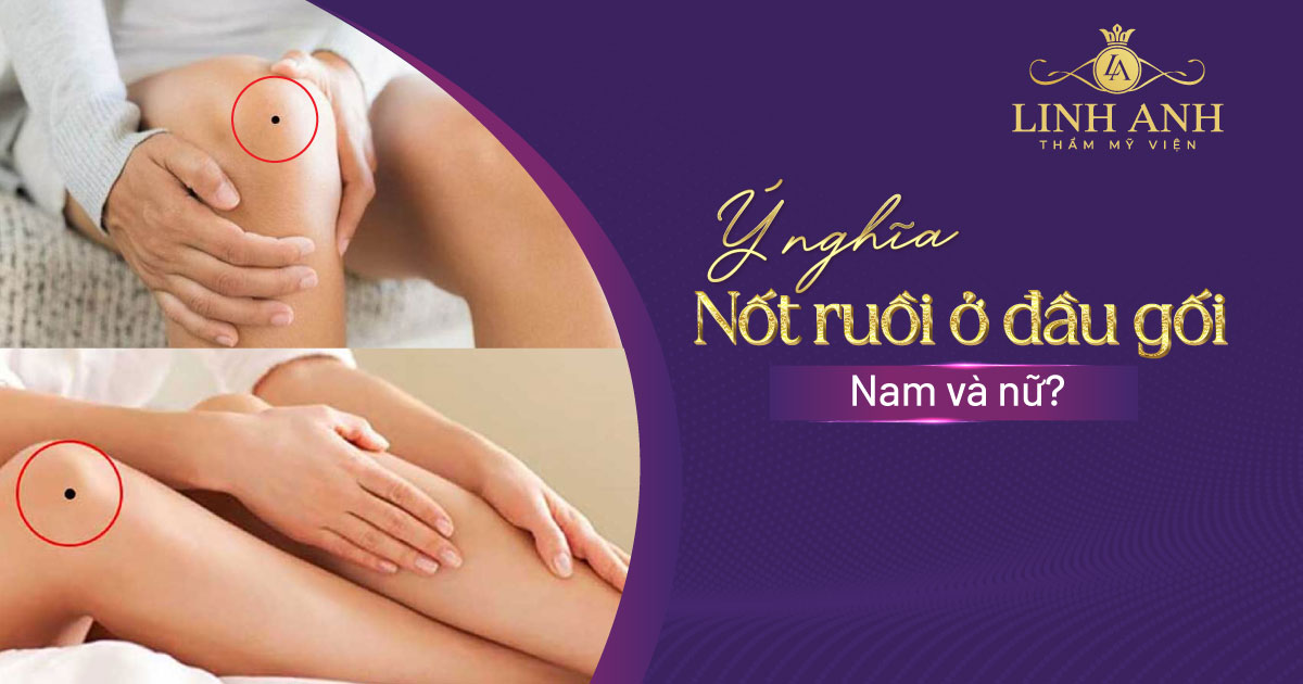 Giải mã ý nghĩa nốt ruồi ở đầu gối nam và nữ chi tiết nhất