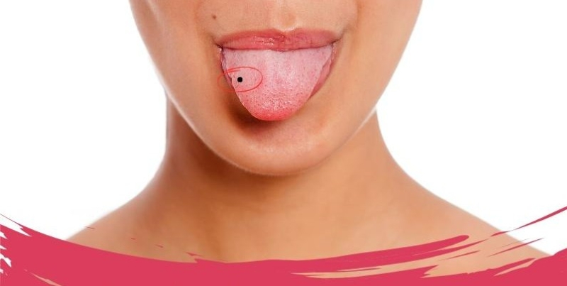Nốt ruồi ở dưới lưỡi