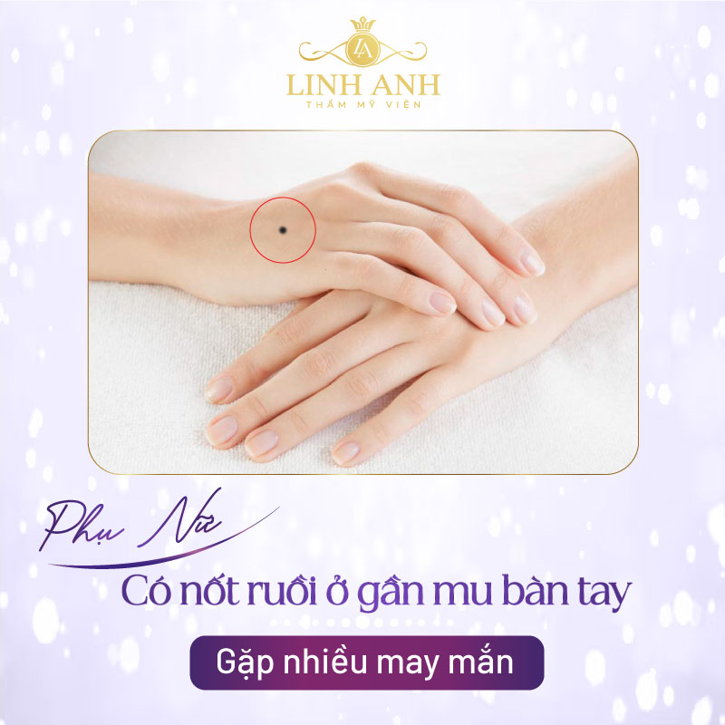 Nốt ruồi ở gần mu bàn tay