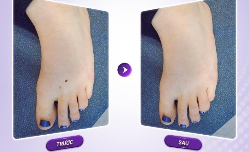 nốt ruồi ở lòng bàn chân trái nữ