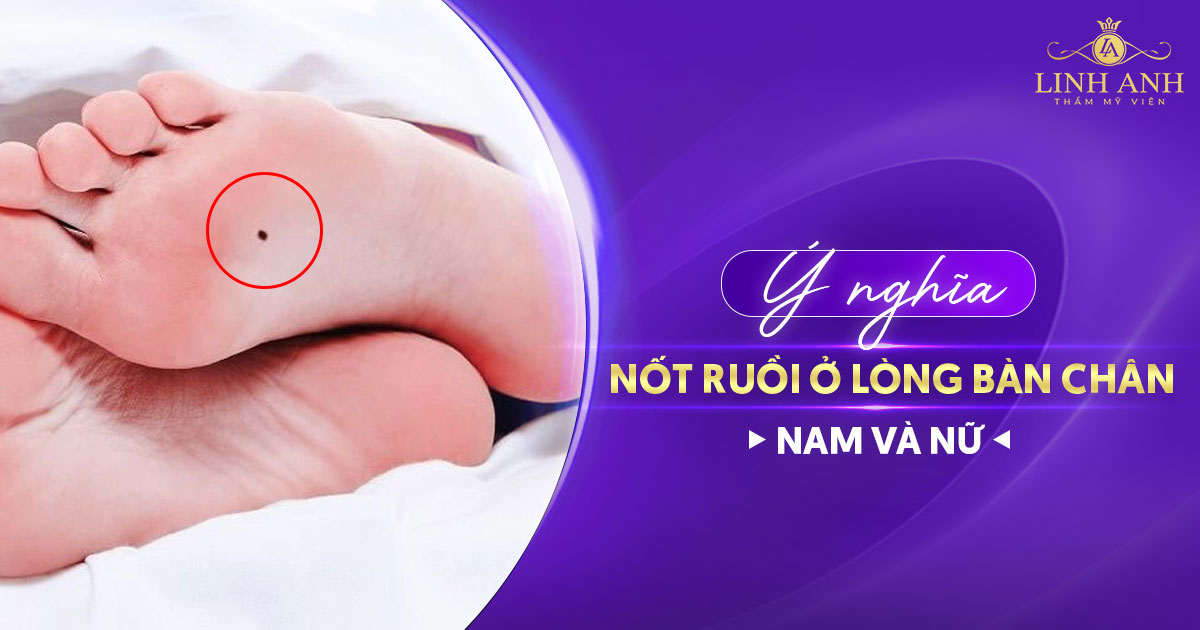 nốt ruồi ở lòng bàn chân
