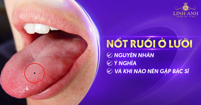Nốt ruồi ở lưỡi: Nguyên nhân, Ý nghĩa và khi nào cần gặp Bác sĩ?
