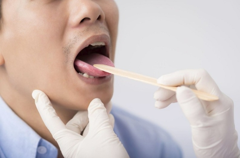 Nốt ruồi ở lưỡi nam