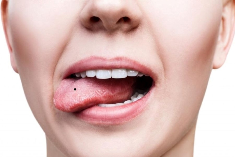 Nốt ruồi ở lưỡi nữ