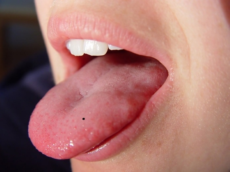 Nốt ruồi ở lưỡi trái