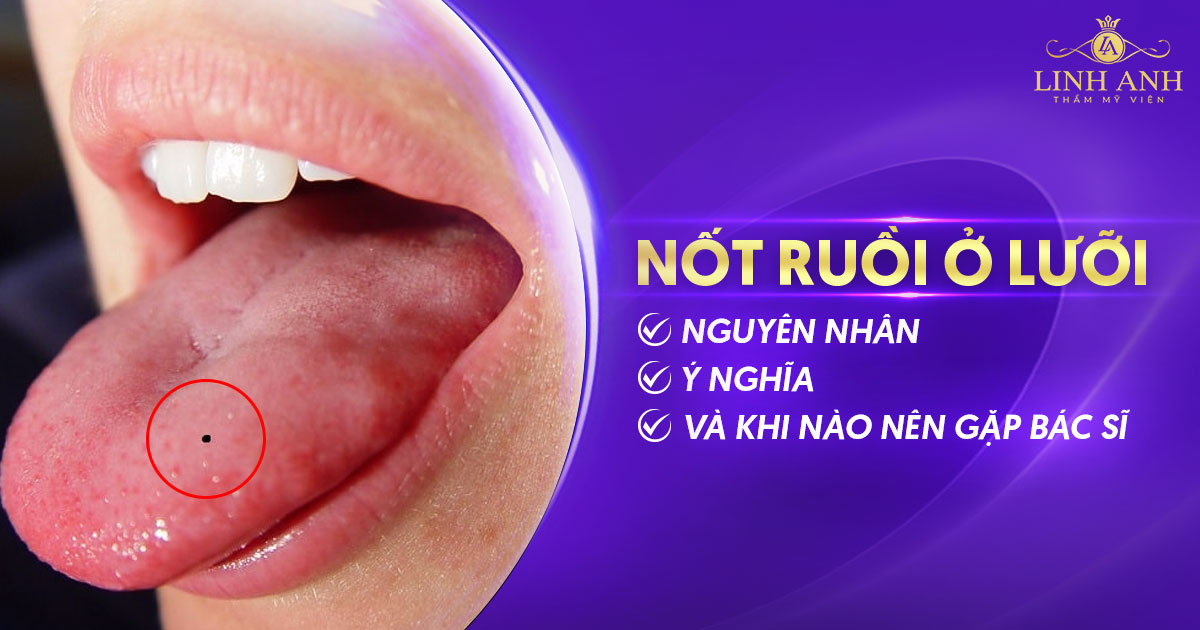 Nốt ruồi ở lưỡi