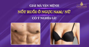 nốt ruồi ở ngực