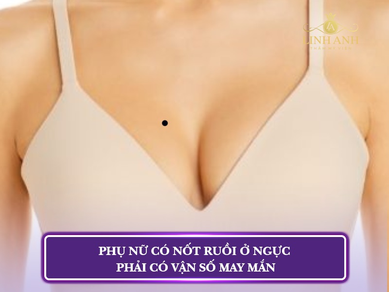 nốt ruồi ở ngực phụ nữ
