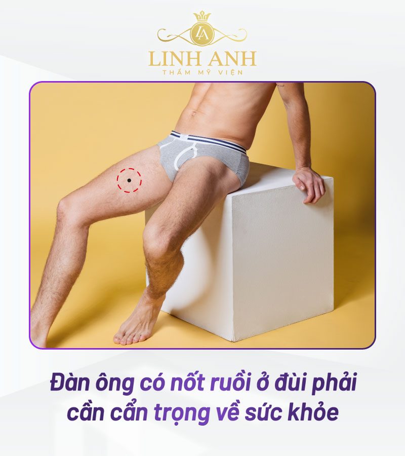 Nốt ruồi ở sau đùi