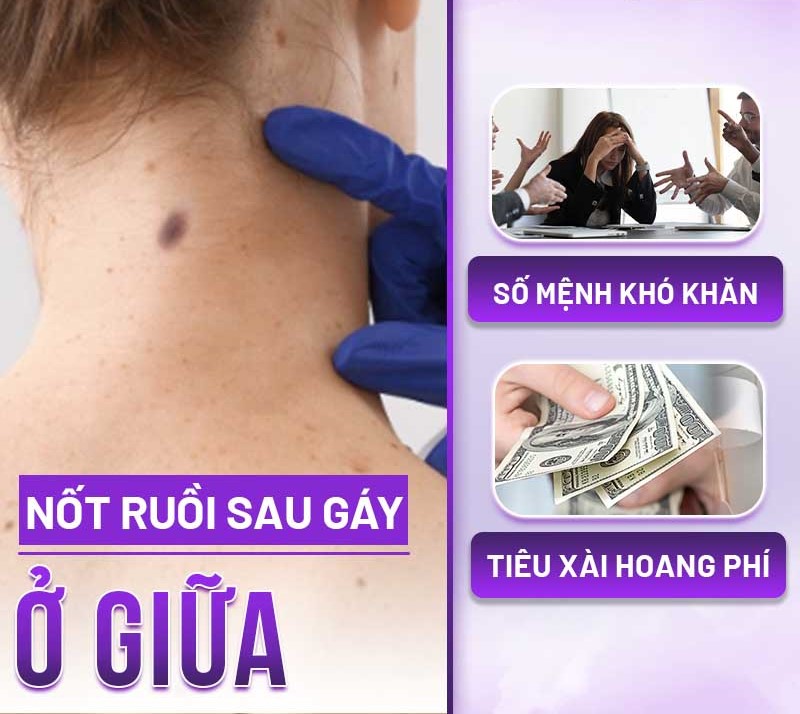 nốt ruồi sau cổ
