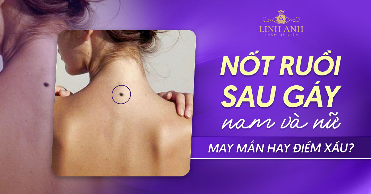 Ý nghĩa của nốt ruồi sau gáy của đàn ông và phụ nữ