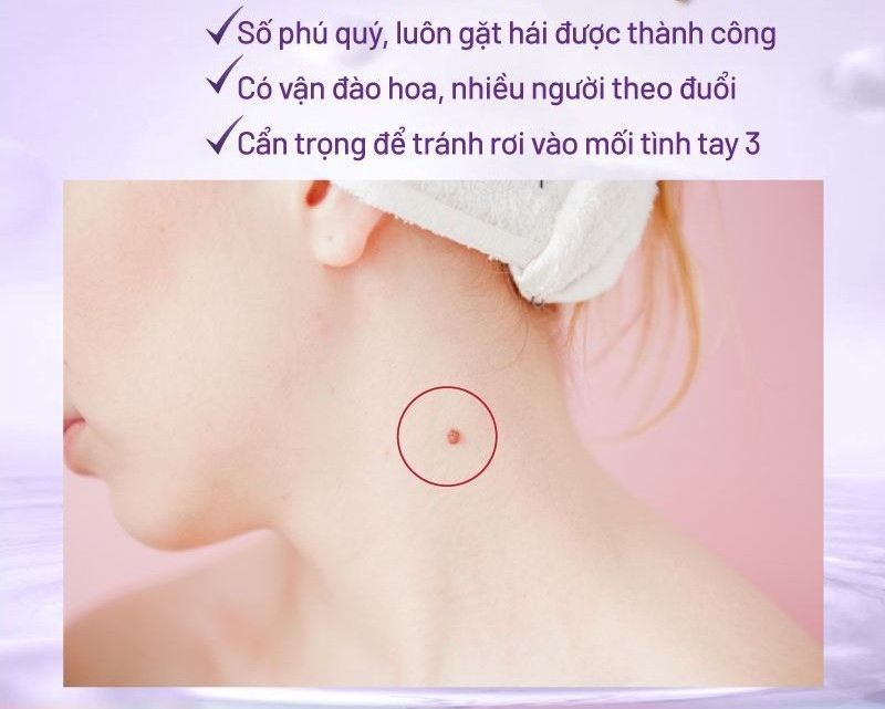 Nốt ruồi son mọc ở cổ