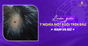 nốt ruồi trên đầu