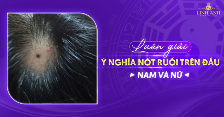 Xem tướng nốt ruồi trên đầu bên trái, phải của Nam & Nữ