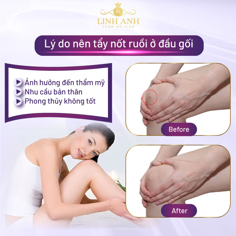 nốt ruồi trên đầu gối