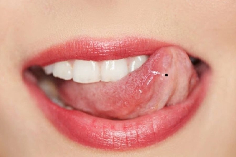 Nốt ruồi trên lưỡi