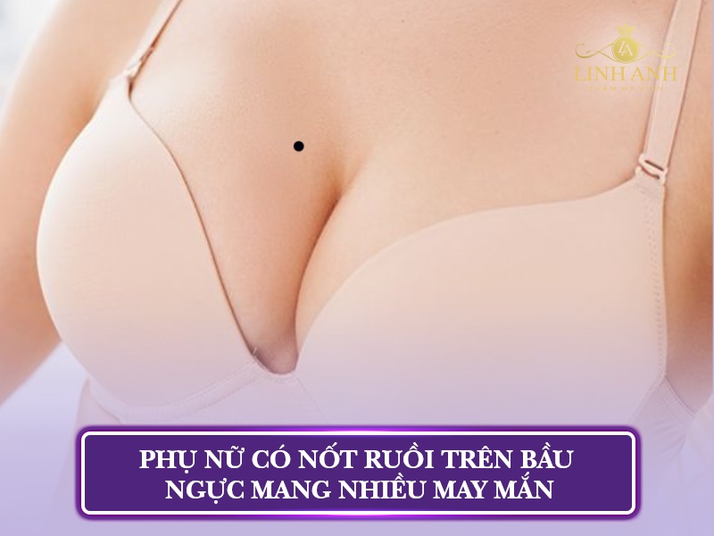 nốt ruồi trên ngực