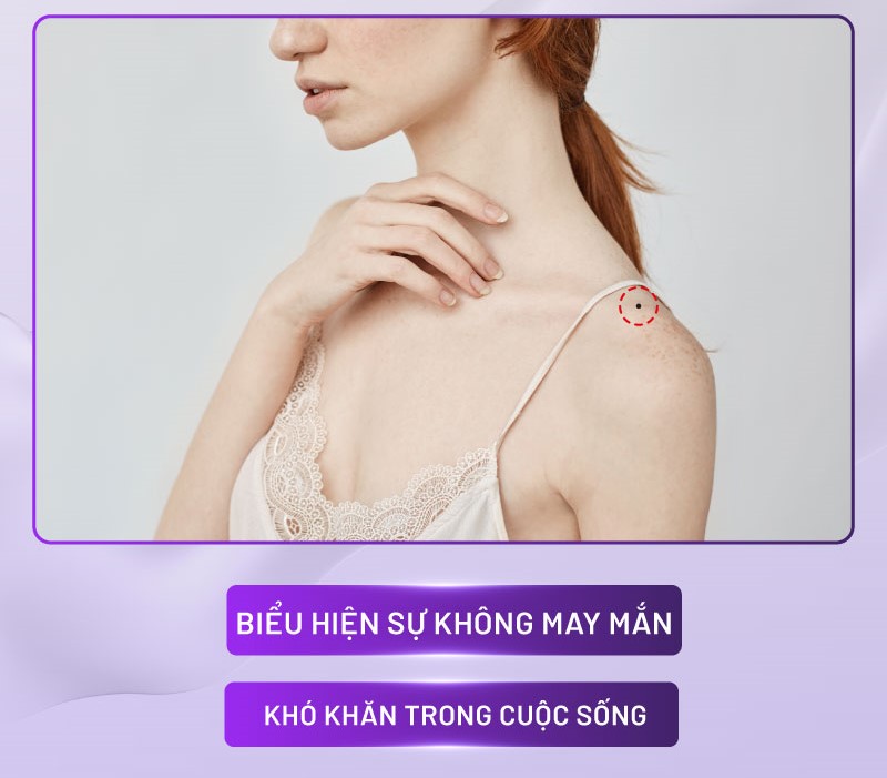 nốt ruồi trên vai nốt ruồi trên vai