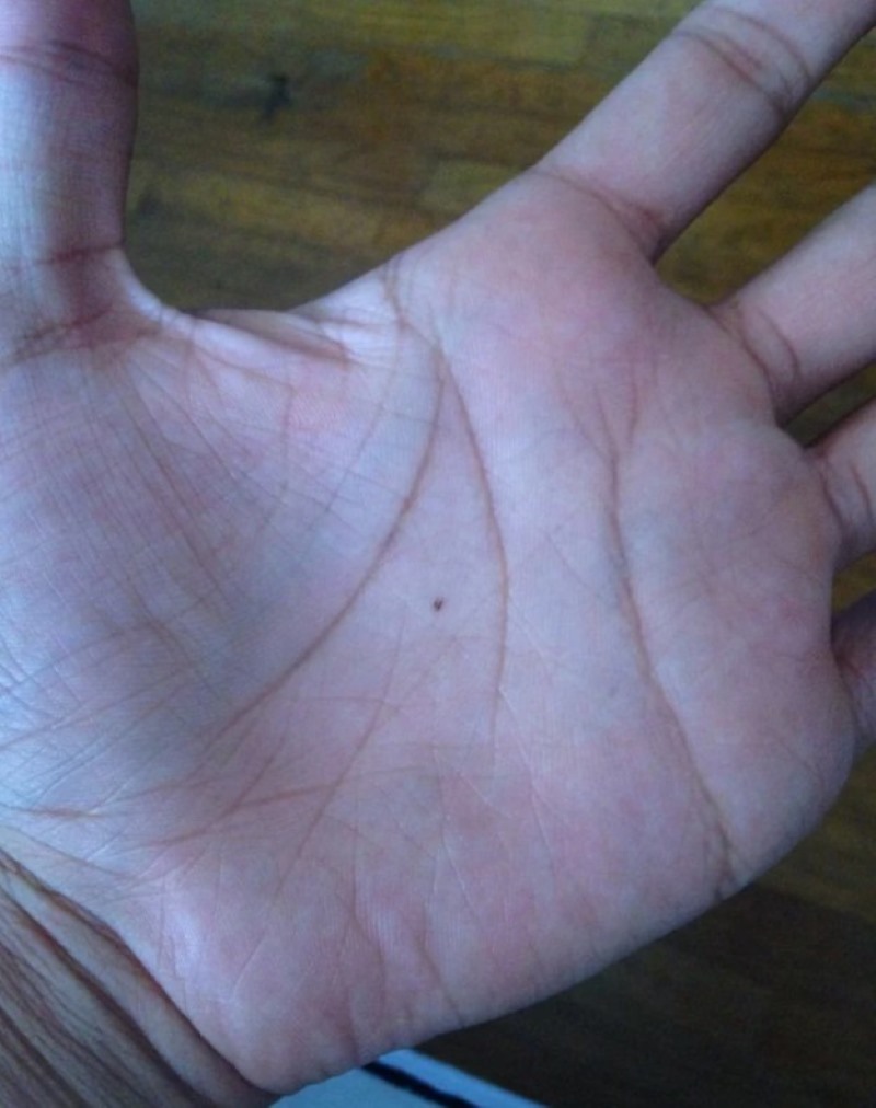 Nốt ruồi trong lòng bàn tay trái của nam