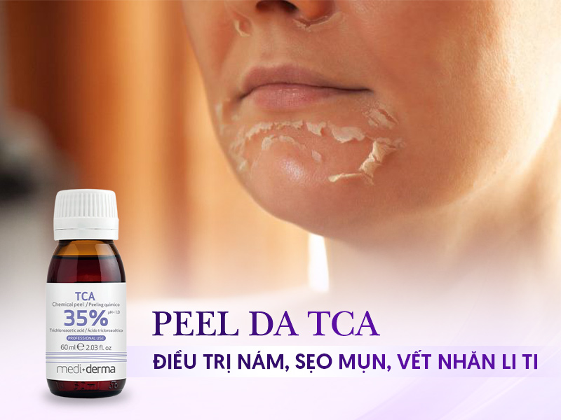 Peel TCA là gì