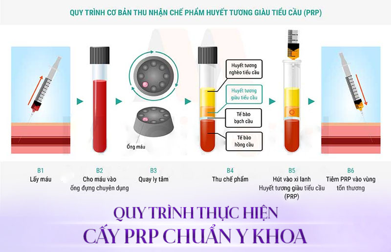 phương pháp prp là gì