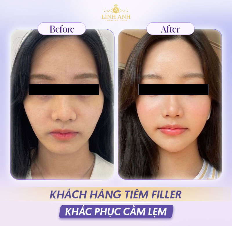 Review tiêm filler cằm lẹm