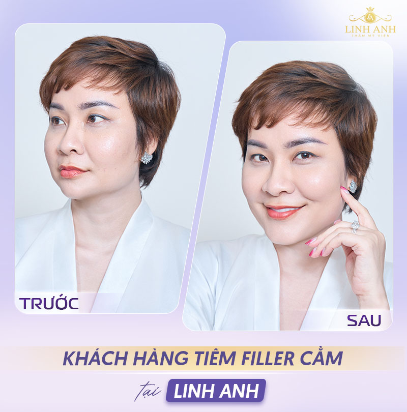 Review Tiêm filler cằm