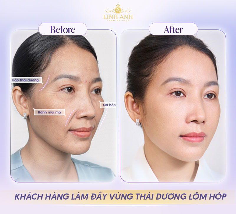 Review Tiêm filler thái dương