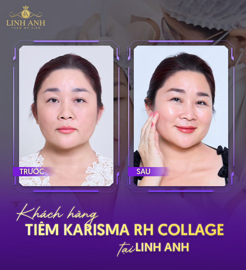 review tiêm Karisma collagen