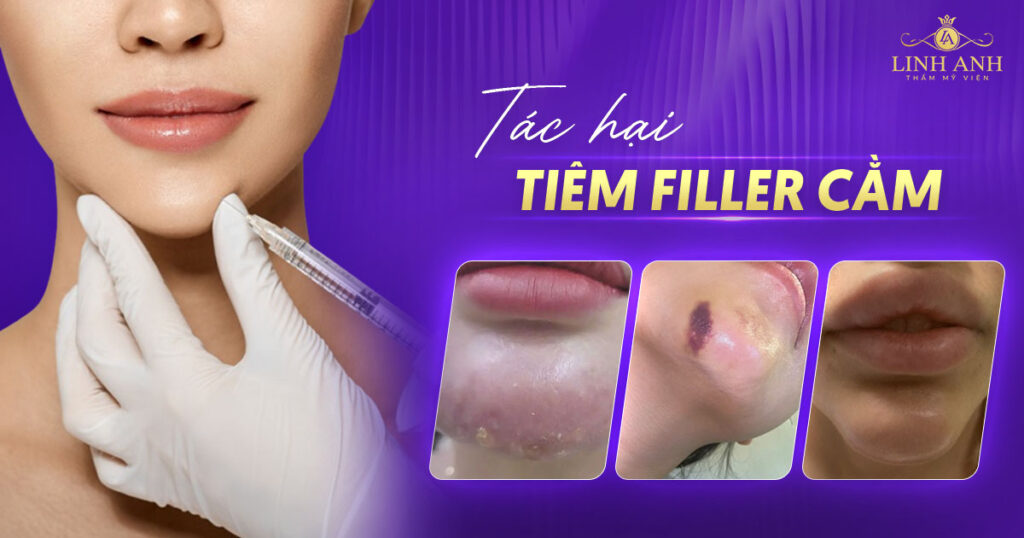 Tác hại của tiêm filler cằm